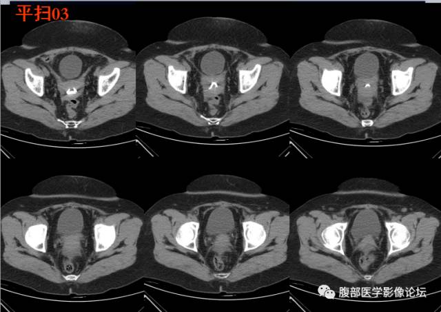 【病例】腹壁脂膜炎一例CT 【病例】腹壁脂膜炎一例CT