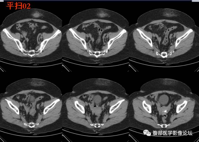 【病例】腹壁脂膜炎一例CT 【病例】腹壁脂膜炎一例CT