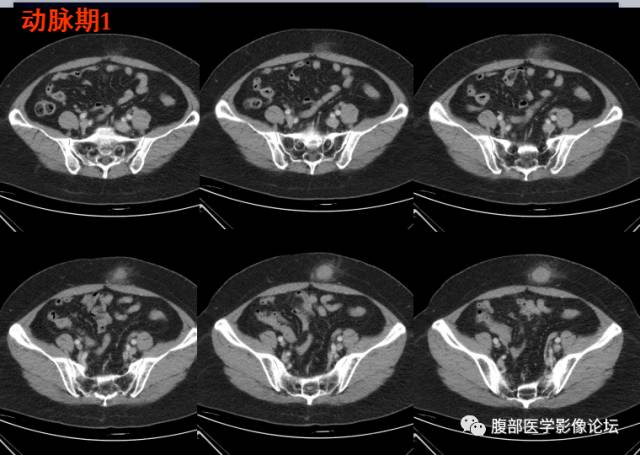 【病例】腹壁脂膜炎一例CT 【病例】腹壁脂膜炎一例CT