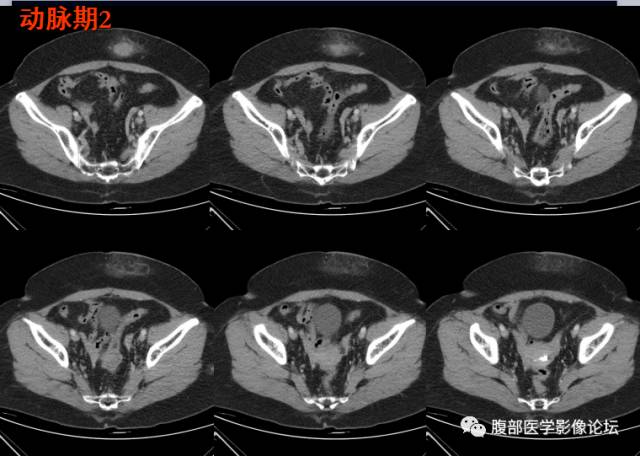 【病例】腹壁脂膜炎一例CT 【病例】腹壁脂膜炎一例CT