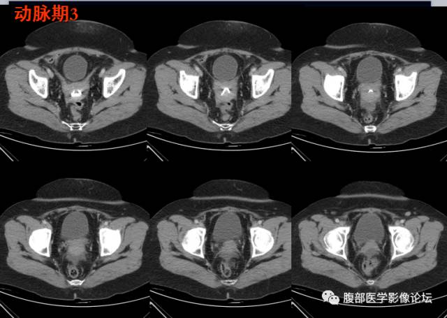 【病例】腹壁脂膜炎一例CT 【病例】腹壁脂膜炎一例CT