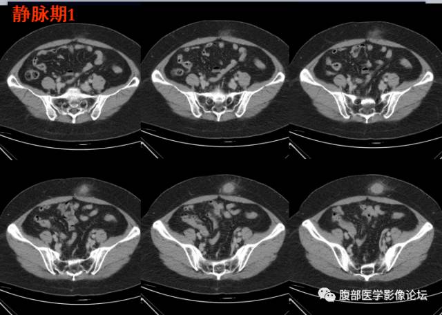 【病例】腹壁脂膜炎一例CT 【病例】腹壁脂膜炎一例CT