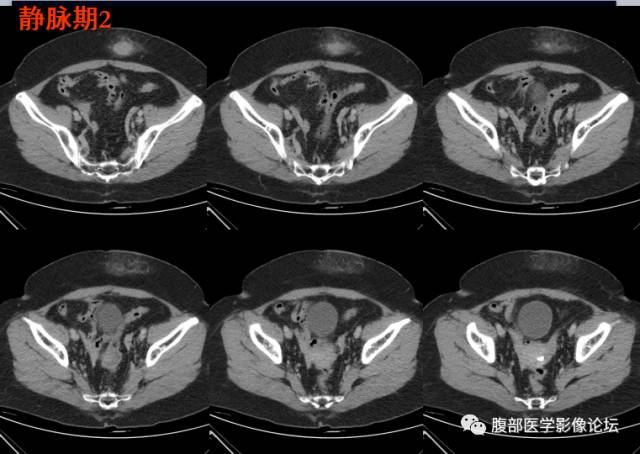 【病例】腹壁脂膜炎一例CT 【病例】腹壁脂膜炎一例CT
