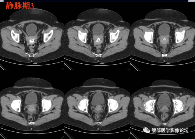 【病例】腹壁脂膜炎一例CT 【病例】腹壁脂膜炎一例CT