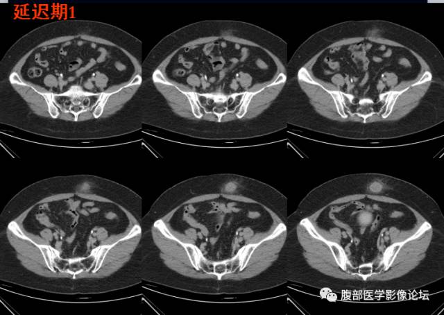 【病例】腹壁脂膜炎一例CT 【病例】腹壁脂膜炎一例CT