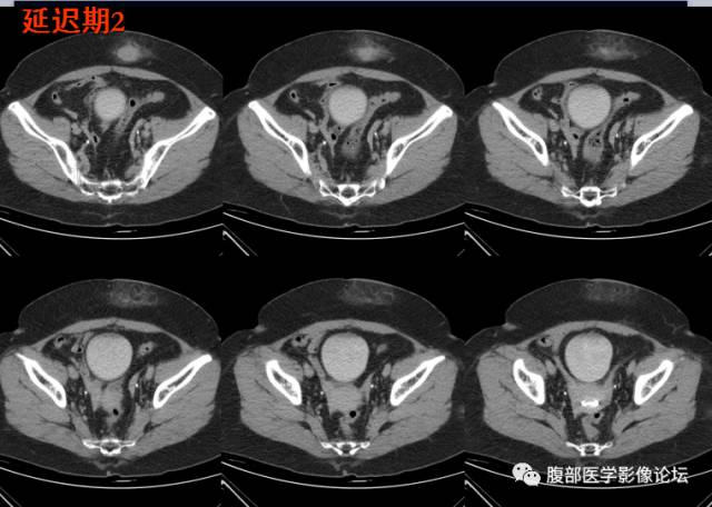 【病例】腹壁脂膜炎一例CT 【病例】腹壁脂膜炎一例CT