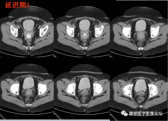 【病例】腹壁脂膜炎一例CT 【病例】腹壁脂膜炎一例CT