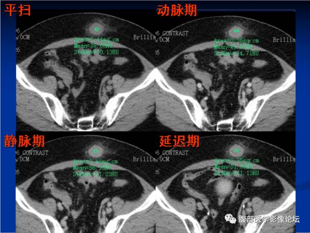 【病例】腹壁脂膜炎一例CT 【病例】腹壁脂膜炎一例CT