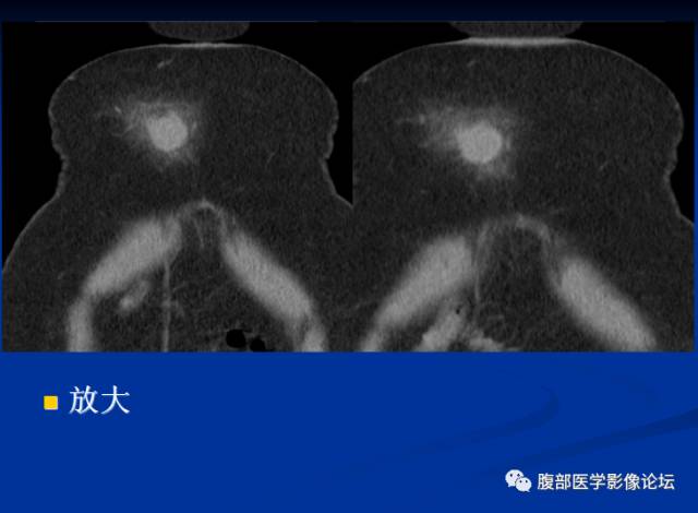 【病例】腹壁脂膜炎一例CT 【病例】腹壁脂膜炎一例CT