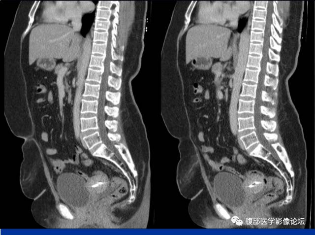 【病例】腹壁脂膜炎一例CT 【病例】腹壁脂膜炎一例CT
