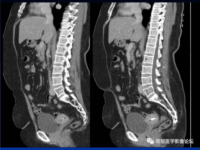 【病例】腹壁脂膜炎一例CT 【病例】腹壁脂膜炎一例CT