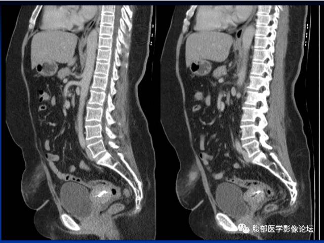 【病例】腹壁脂膜炎一例CT 【病例】腹壁脂膜炎一例CT
