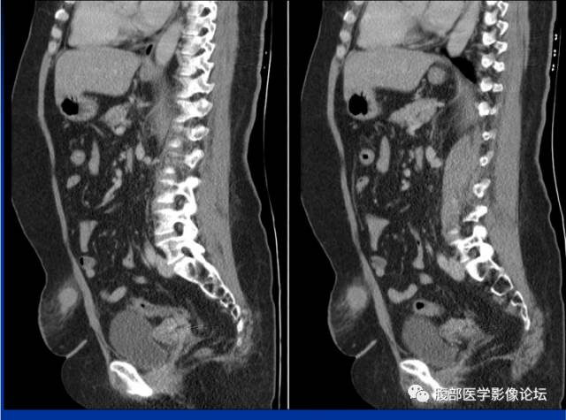 【病例】腹壁脂膜炎一例CT 【病例】腹壁脂膜炎一例CT