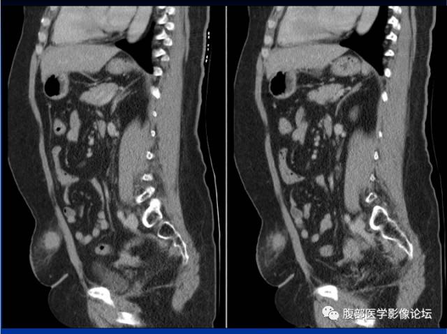 【病例】腹壁脂膜炎一例CT 【病例】腹壁脂膜炎一例CT