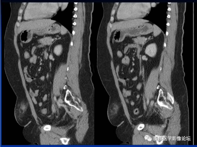 【病例】腹壁脂膜炎一例CT 【病例】腹壁脂膜炎一例CT