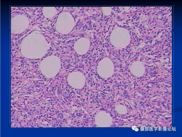 【病例】腹壁脂膜炎一例CT 【病例】腹壁脂膜炎一例CT
