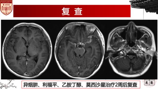 【病例】脑结核1例MR影像诊断