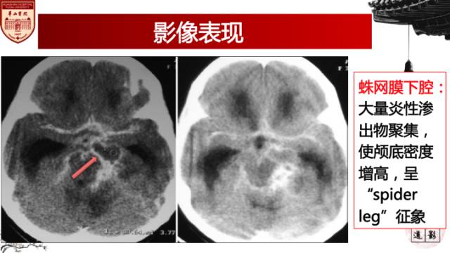 【病例】脑结核1例MR影像诊断