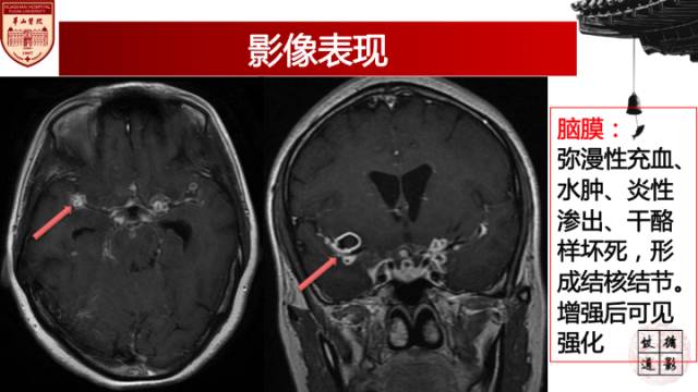 【病例】脑结核1例MR影像诊断