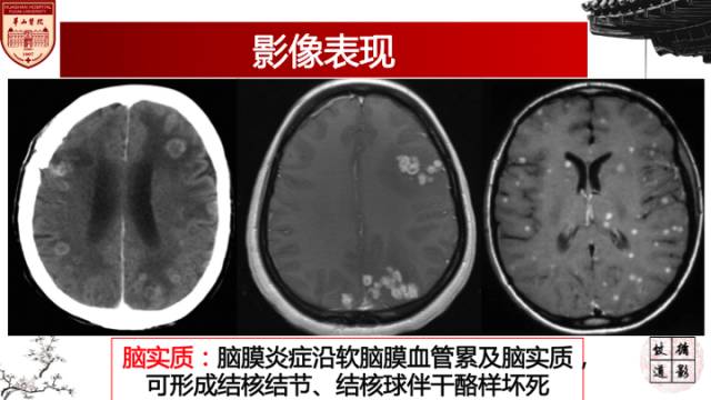 【病例】脑结核1例MR影像诊断