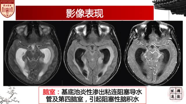 【病例】脑结核1例MR影像诊断
