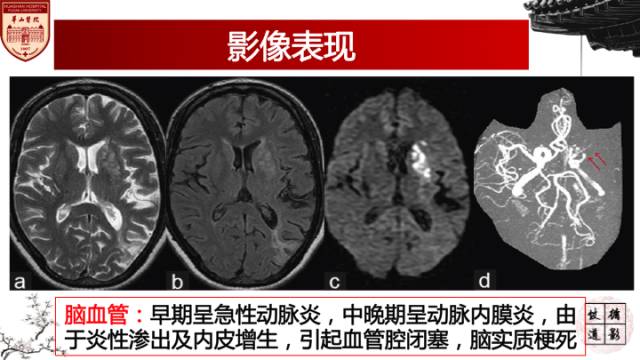 【病例】脑结核1例MR影像诊断