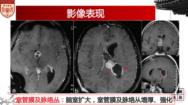 【病例】脑结核1例MR影像诊断