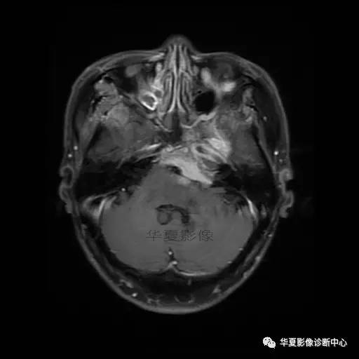 【病例】鼻咽癌鞍区转移瘤1例MR 【病例】鼻咽癌鞍区转移瘤1例MR