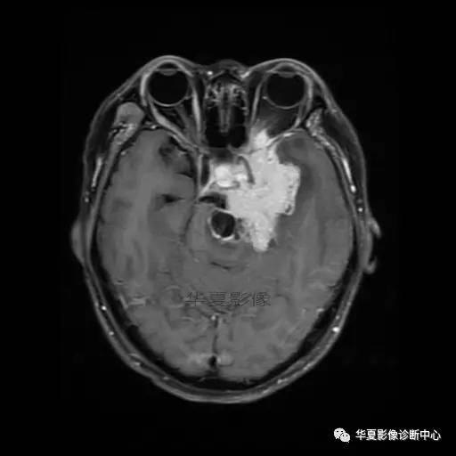 【病例】鼻咽癌鞍区转移瘤1例MR 【病例】鼻咽癌鞍区转移瘤1例MR