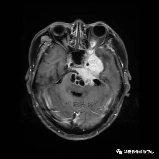 【病例】鼻咽癌鞍区转移瘤1例MR