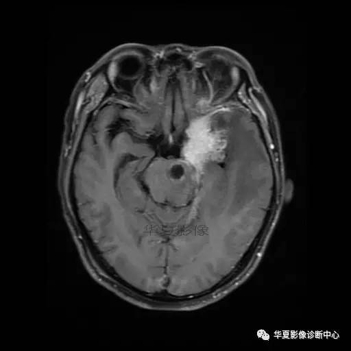 【病例】鼻咽癌鞍区转移瘤1例MR 【病例】鼻咽癌鞍区转移瘤1例MR