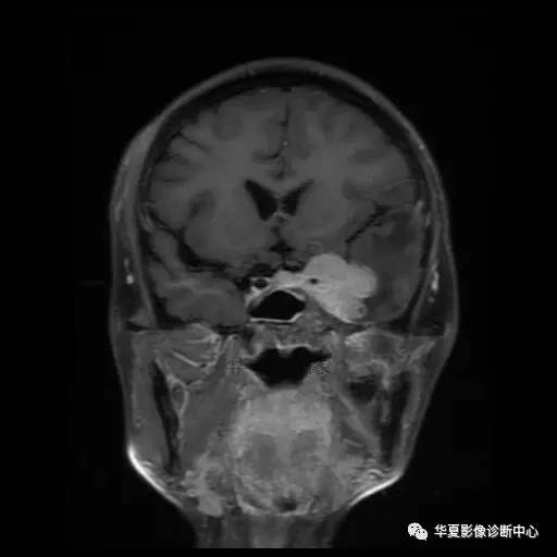 【病例】鼻咽癌鞍区转移瘤1例MR 【病例】鼻咽癌鞍区转移瘤1例MR