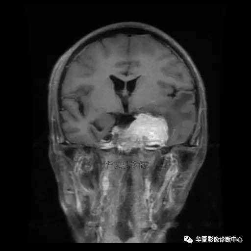 【病例】鼻咽癌鞍区转移瘤1例MR 【病例】鼻咽癌鞍区转移瘤1例MR