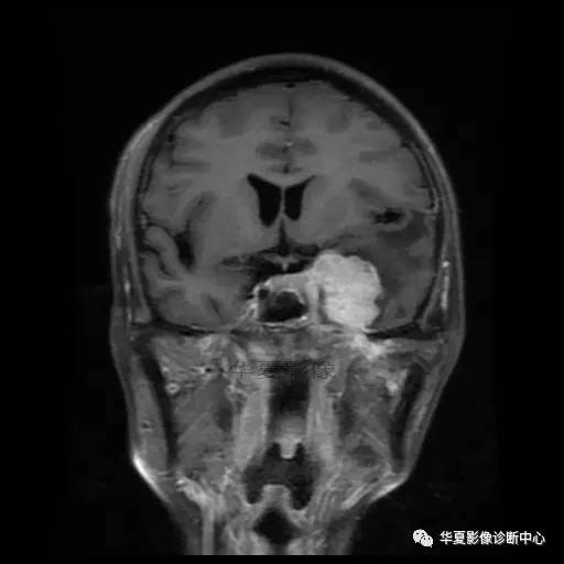 【病例】鼻咽癌鞍区转移瘤1例MR 【病例】鼻咽癌鞍区转移瘤1例MR