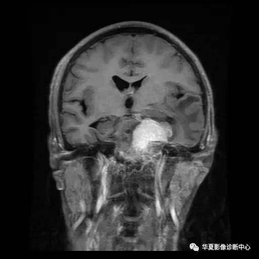 【病例】鼻咽癌鞍区转移瘤1例MR 【病例】鼻咽癌鞍区转移瘤1例MR