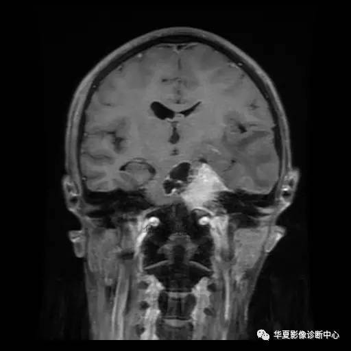 【病例】鼻咽癌鞍区转移瘤1例MR 【病例】鼻咽癌鞍区转移瘤1例MR