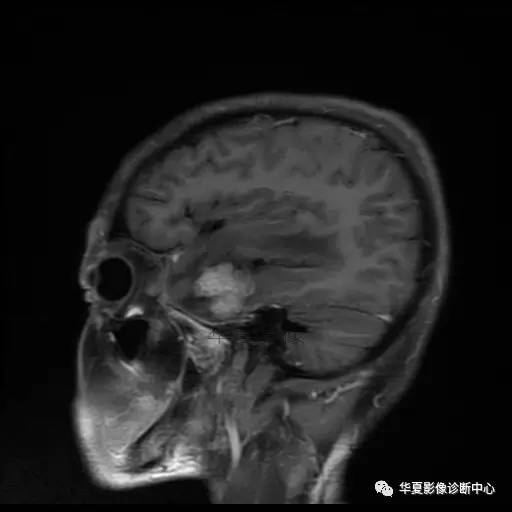 【病例】鼻咽癌鞍区转移瘤1例MR 【病例】鼻咽癌鞍区转移瘤1例MR