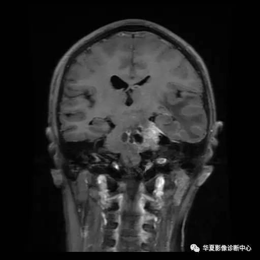 【病例】鼻咽癌鞍区转移瘤1例MR 【病例】鼻咽癌鞍区转移瘤1例MR