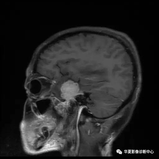【病例】鼻咽癌鞍区转移瘤1例MR 【病例】鼻咽癌鞍区转移瘤1例MR