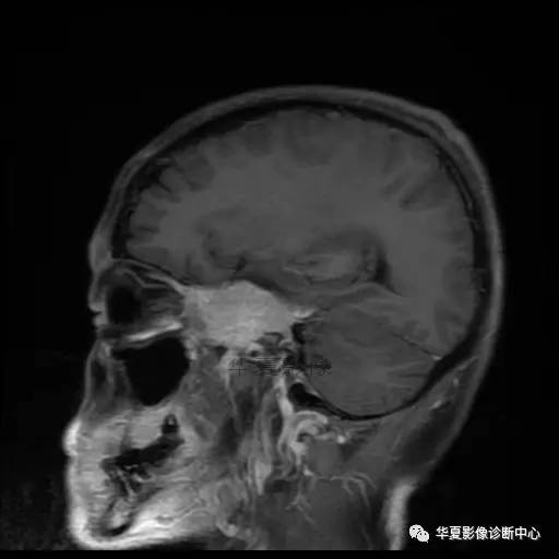 【病例】鼻咽癌鞍区转移瘤1例MR 【病例】鼻咽癌鞍区转移瘤1例MR