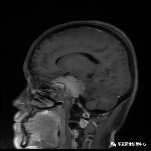 【病例】鼻咽癌鞍区转移瘤1例MR 【病例】鼻咽癌鞍区转移瘤1例MR