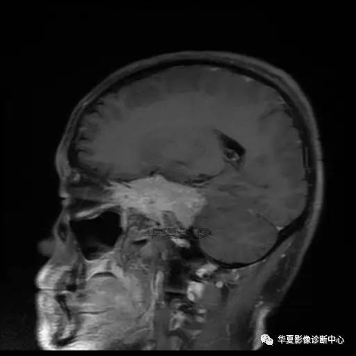 【病例】鼻咽癌鞍区转移瘤1例MR 【病例】鼻咽癌鞍区转移瘤1例MR