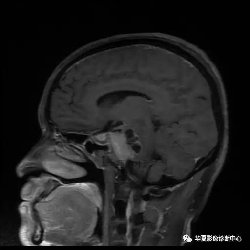 【病例】鼻咽癌鞍区转移瘤1例MR 【病例】鼻咽癌鞍区转移瘤1例MR