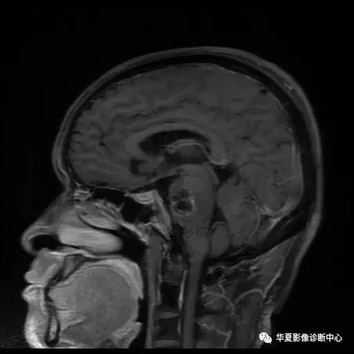 【病例】鼻咽癌鞍区转移瘤1例MR 【病例】鼻咽癌鞍区转移瘤1例MR