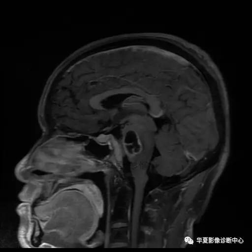 【病例】鼻咽癌鞍区转移瘤1例MR 【病例】鼻咽癌鞍区转移瘤1例MR