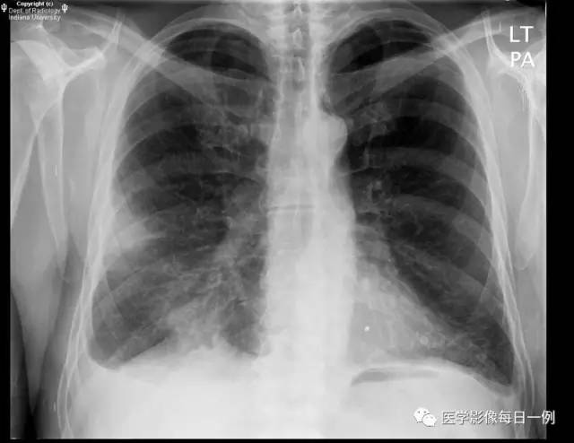 【病例】肺脓肿1例X线及CT 【病例】肺脓肿1例X线及CT