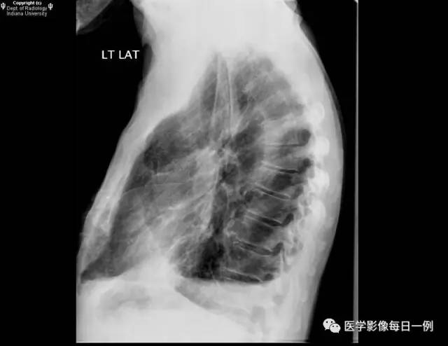 【病例】肺脓肿1例X线及CT 【病例】肺脓肿1例X线及CT