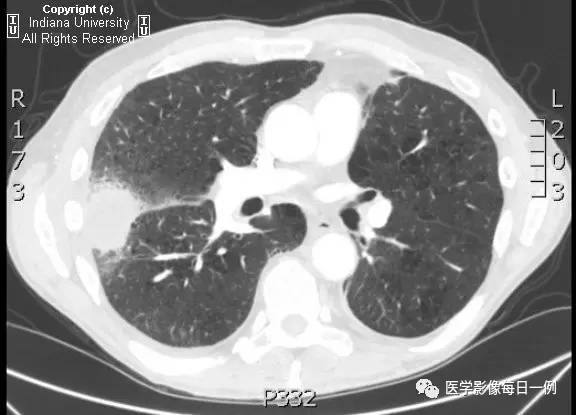 【病例】肺脓肿1例X线及CT 【病例】肺脓肿1例X线及CT