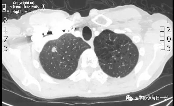 【病例】肺脓肿1例X线及CT 【病例】肺脓肿1例X线及CT