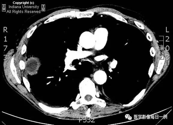 【病例】肺脓肿1例X线及CT